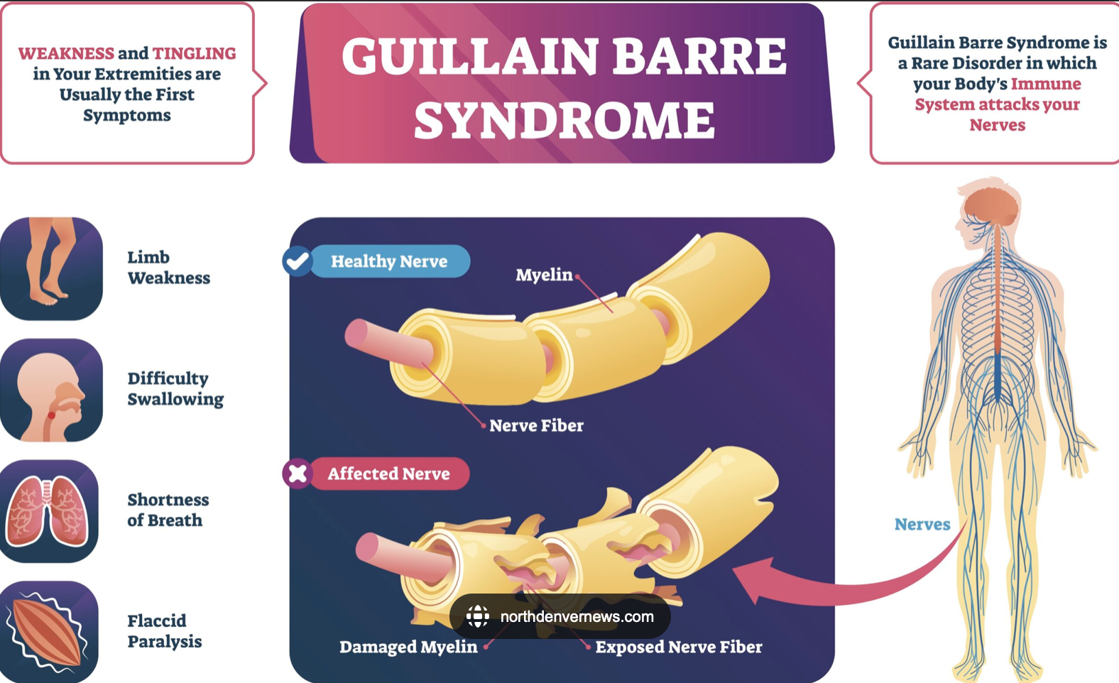 guillain barre syndrome.png